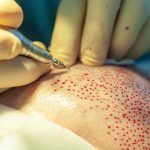 Hair Transplant Surgery in Turkey