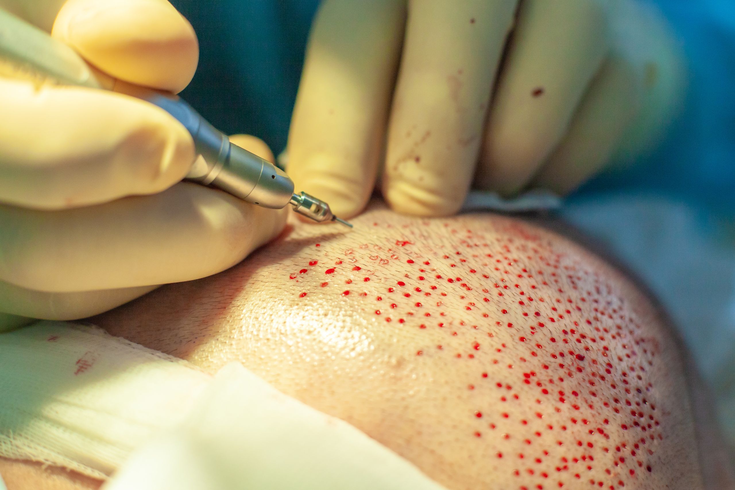 Hair Transplant Surgery in Turkey